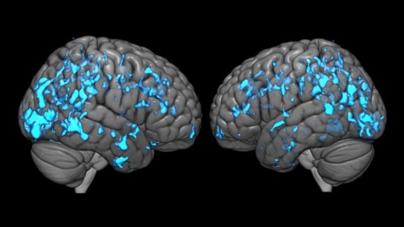 Deep Brain Stimulation Eases Parkinson's Disease Symptoms by