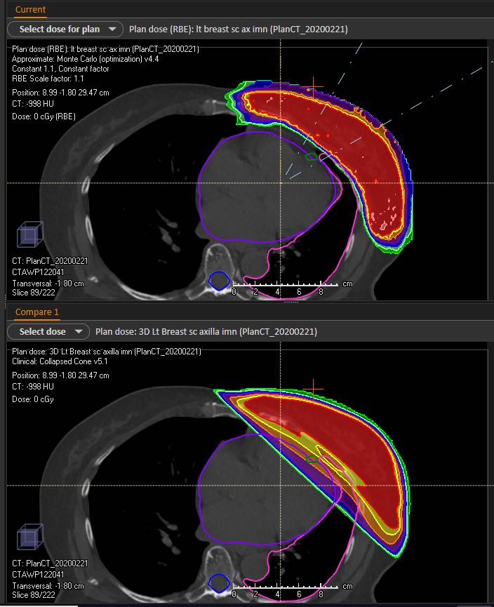 Radiation Therapies for Breast Cancer