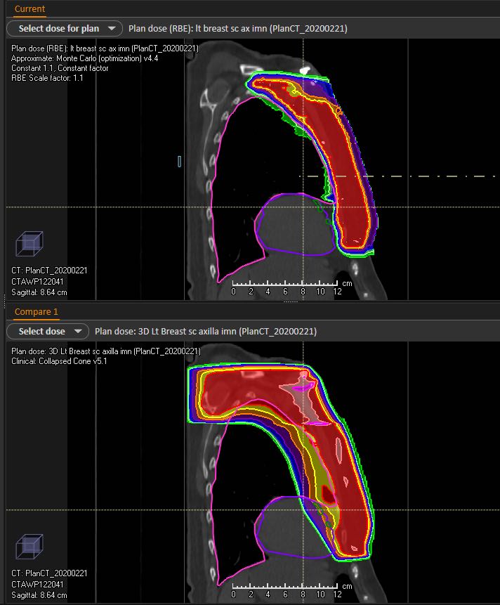 Proton Therapy FAQs for Breast Cancer - Johns Hopkins Medicine