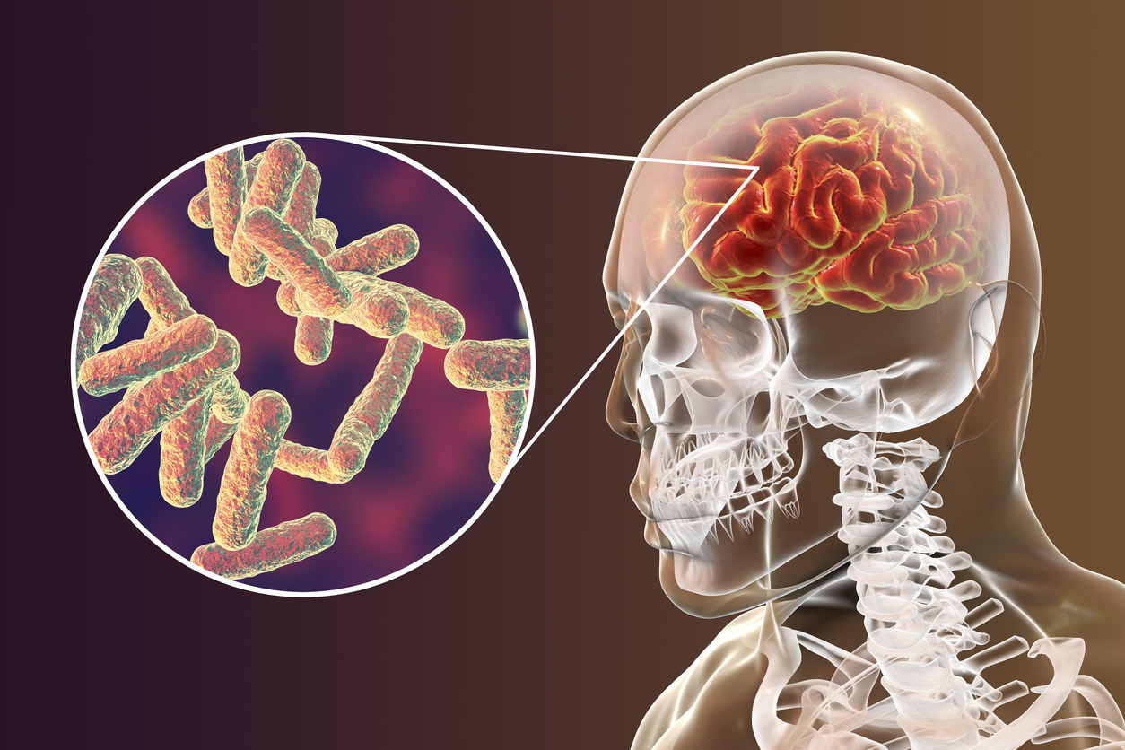 PET Scans May Optimize Tuberculosis Meningitis Treatments And 