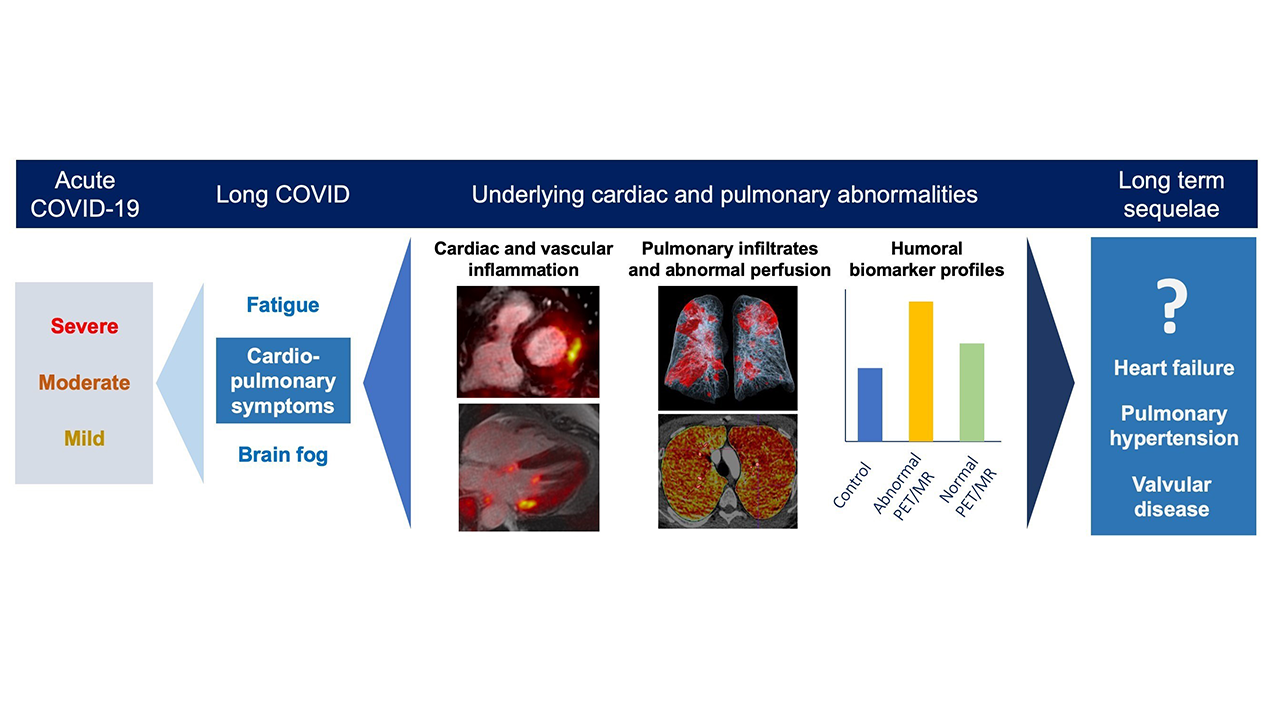 Long COVID May Cause LongTerm Changes in the Heart and Lungs and May