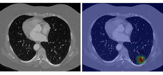 Lung CT