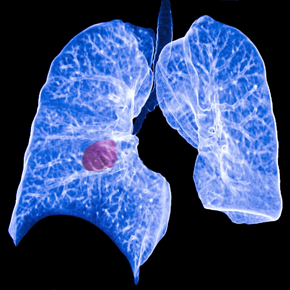 lung cancer CT