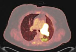 Baseline PET image and CT images (no treatment yet)