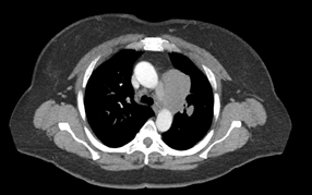 Baseline PET image and CT images (no treatment yet)