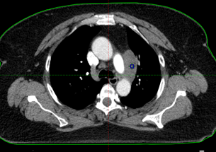 CT after first cycle of chemo (used for radiation mapping)