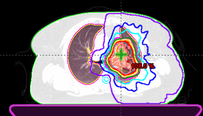 Image of radiation plan