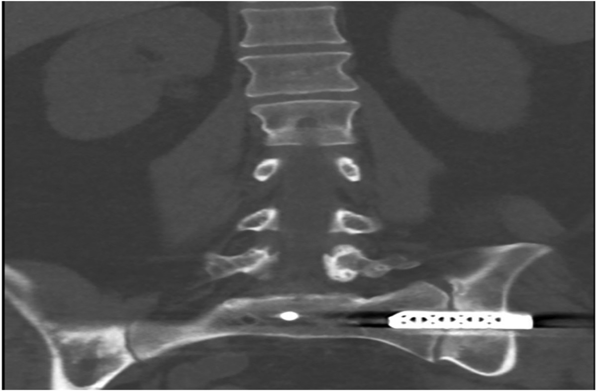 Minimally Invasive Removal of Failed Sacroiliac Fusion Implants