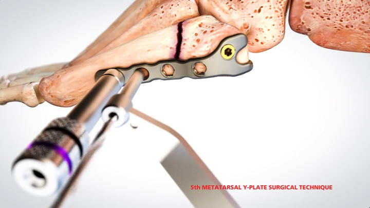 ORTHOLOC™ 3Di Small Bone Plating System Animation [015508