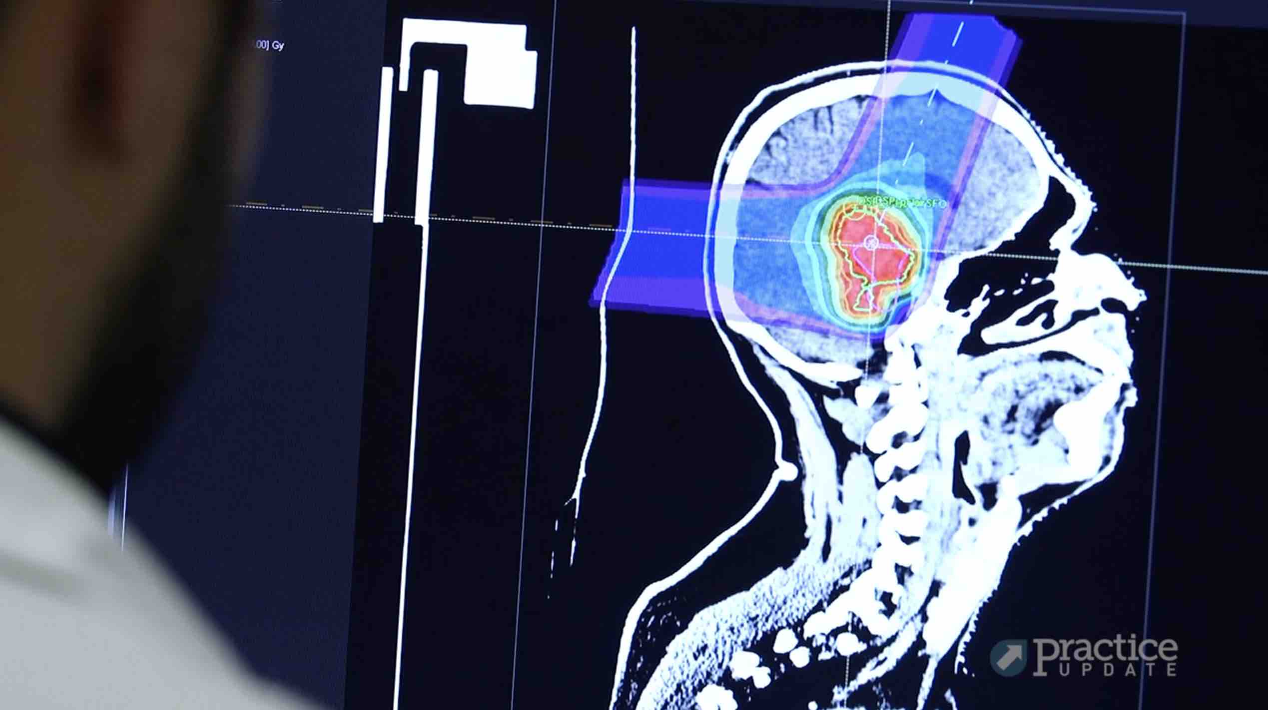 Current Radiation Treatment Approaches for Brain Metastases BroadcastMed