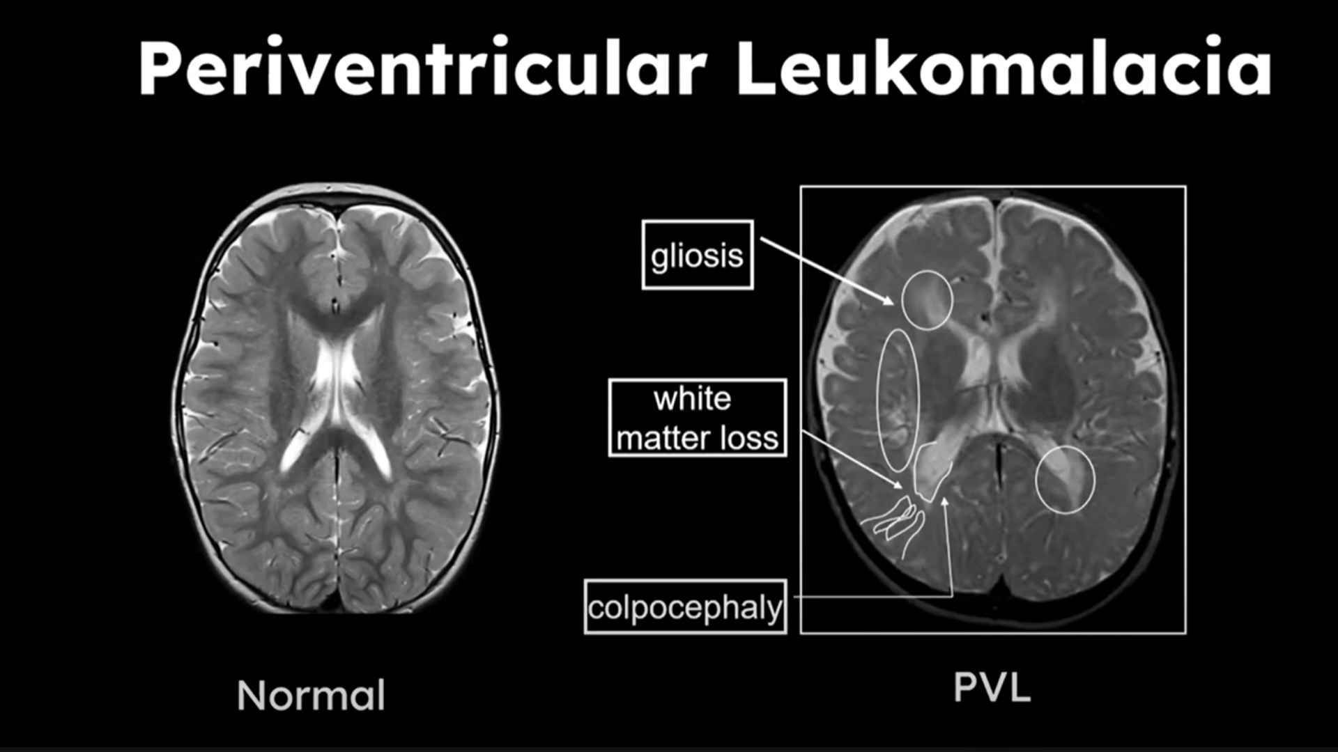 Cerebral White Matter Posterior Deficiency Neuroradiology radiology