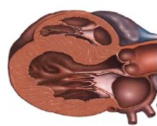 Heart scan showing enlarged heart - Figure 1