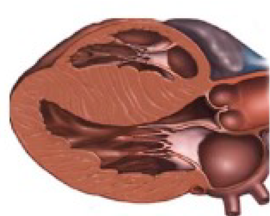 Heart scan showing enlarged heart - Figure 2