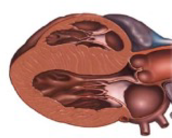 Heart scan showing enlarged heart - Figure 3