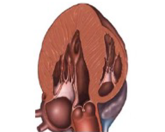 Heart scan showing enlarged heart - Figure 4