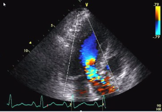 Figure 5, Color flow showing the mosaic, turbulent jet at the level of the left ventricular outflow tract.