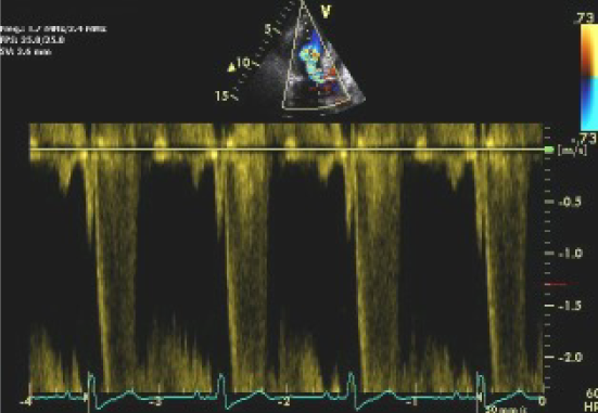 Heart scan showing enlarged heart - Figure 6