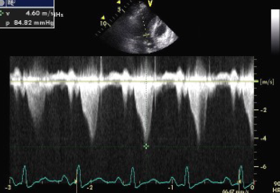 Figure 7, A late-peaking CW Doppler signal — the visual signature of dynamic obstruction.