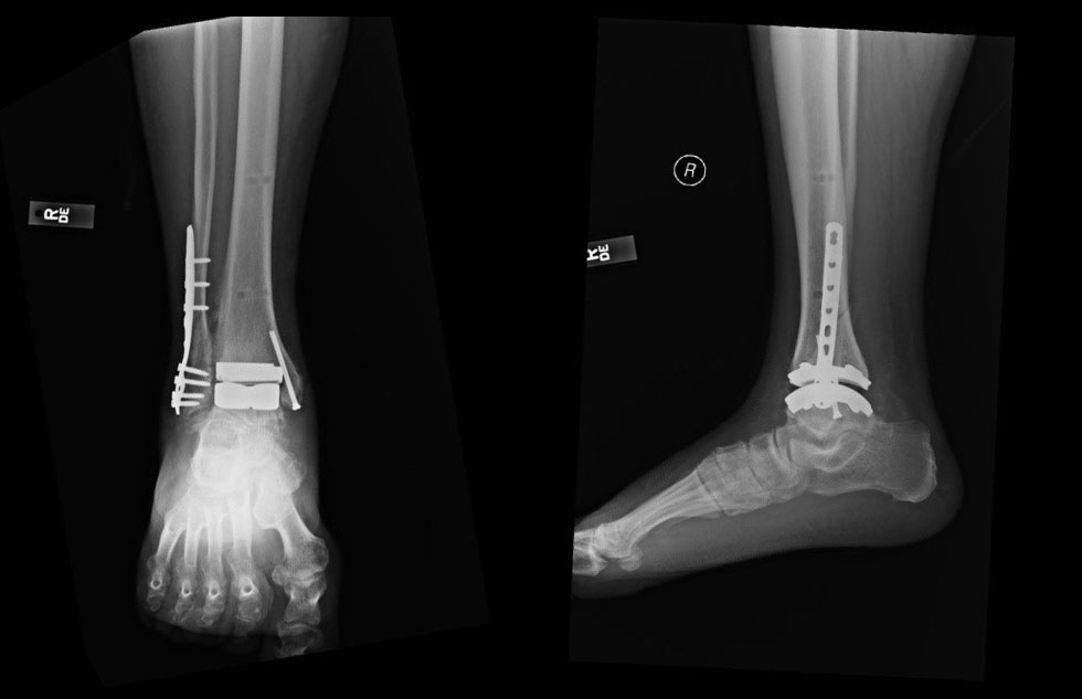 Who is the ideal candidate for total ankle arthroplasty?