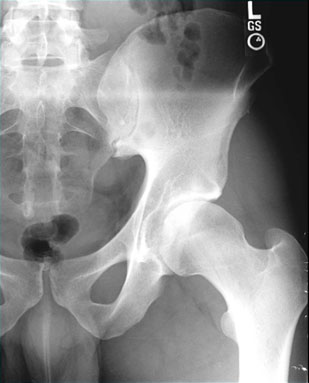 x-ray of hip