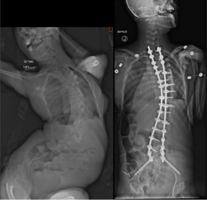 Adelynn's curvature before and after surgery
