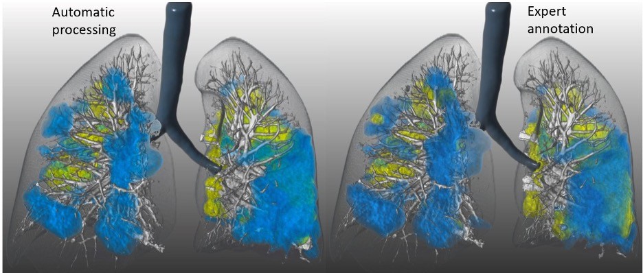 AI_model_lung_lesions