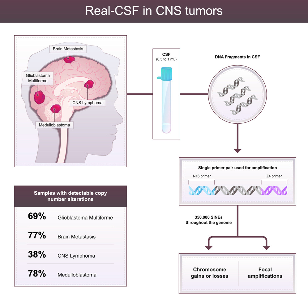 Investigators Devise Test to Identify Brain Tumors from Cerebrospinal Fluid