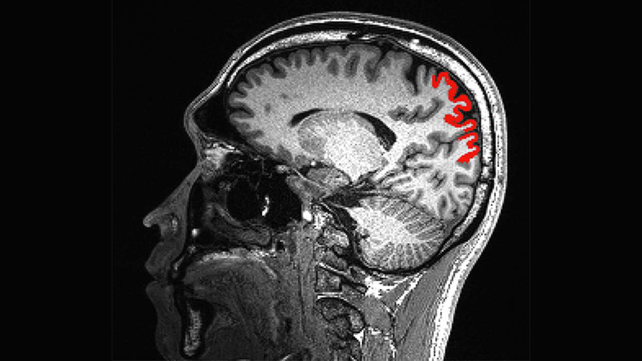 Lifelong physical activity may slow cognitive decline - UT Southwestern ...