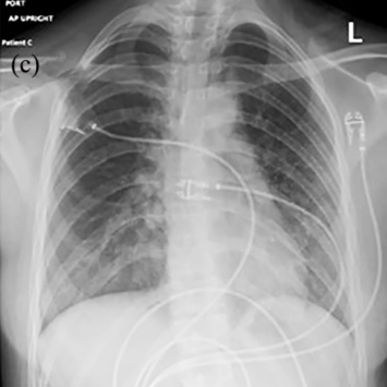 chest-xray-350