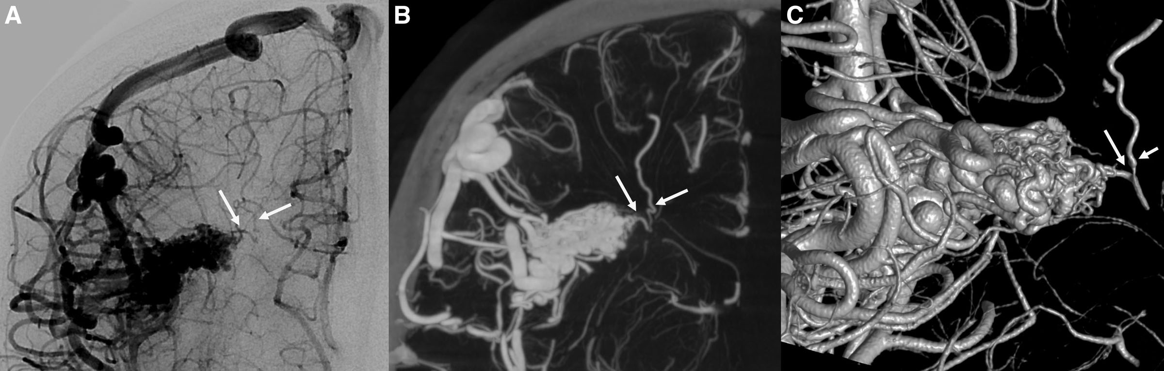 gital subtraction angiography and cone beam computed angiography of a right hemispheric brain arteriovenous malformation