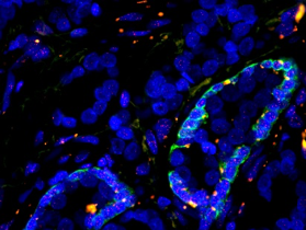 Gleason 9-10 Prostate Cancer