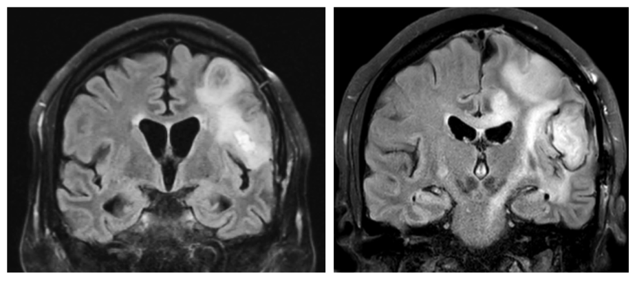 Recurrent glioblastoma – migration and invasion into normal brain.