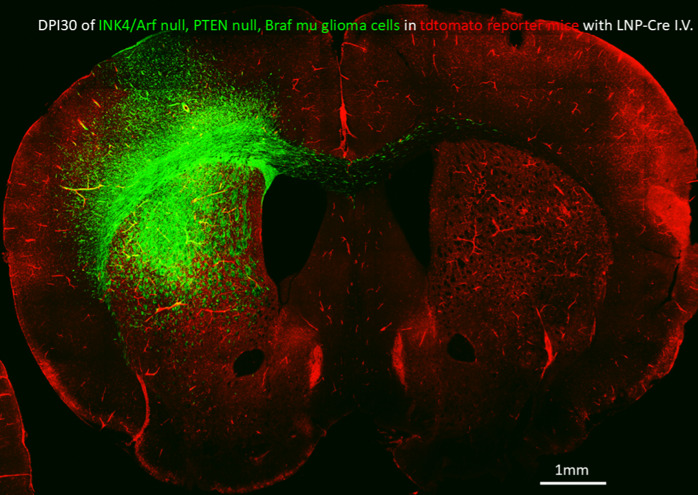Glioblastoma Green cells migrating in the brain of a mouse
