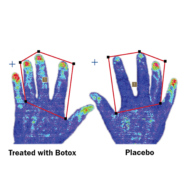 Easing Raynauds In Scleroderma Patients Johns Hopkins Medicine