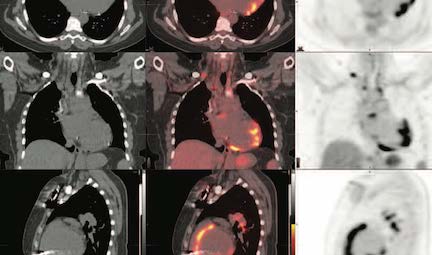 Advanced Sarcoidosis