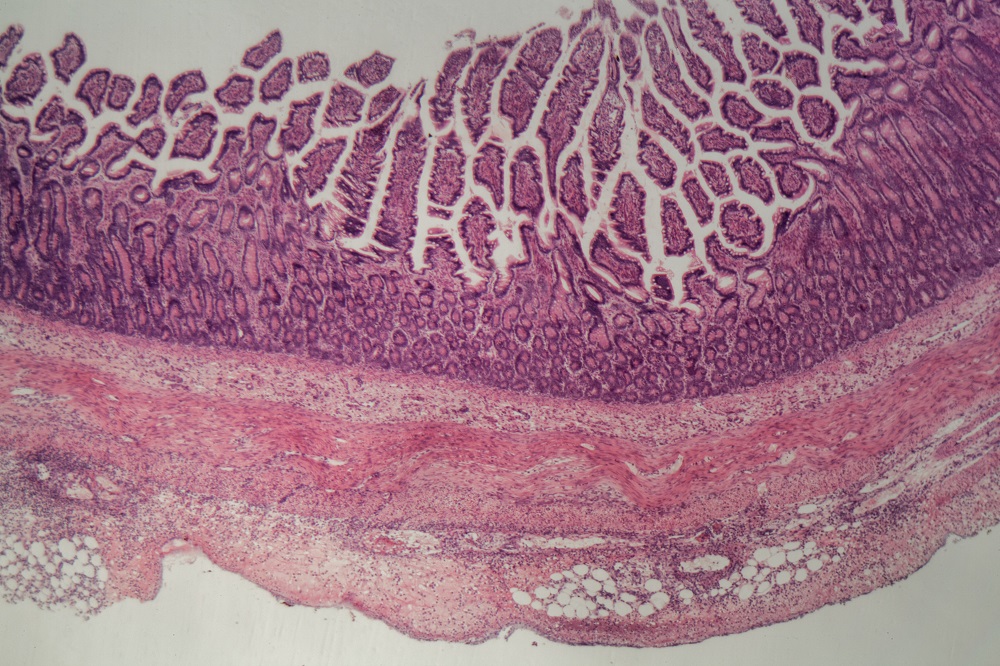 Inflamed_intestine