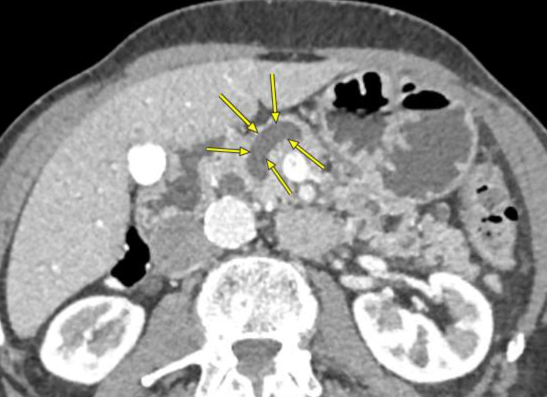 Medical imaging shows an intraductal papillary mucinous neoplasm (IPMN), a dark gray area highlighted by yellow arrows