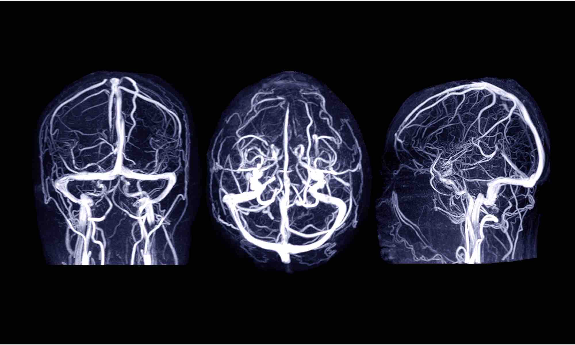 stroke-rehab