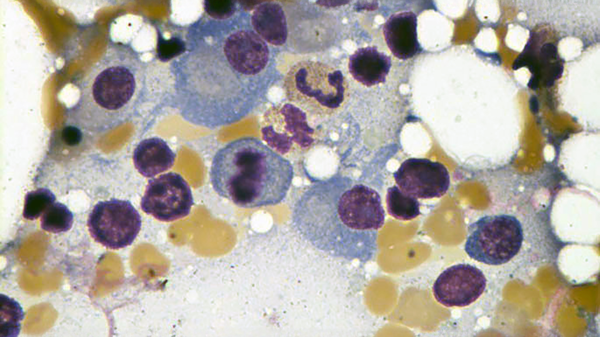 Cancer Cells
