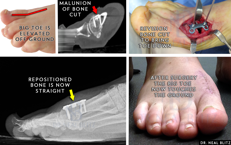 malunion metatarsal