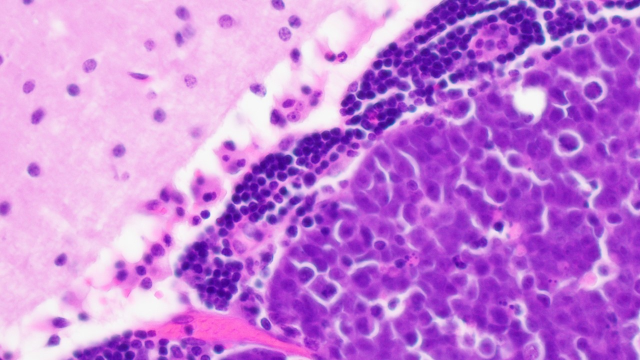 MYC_amplified_medulloblastoma