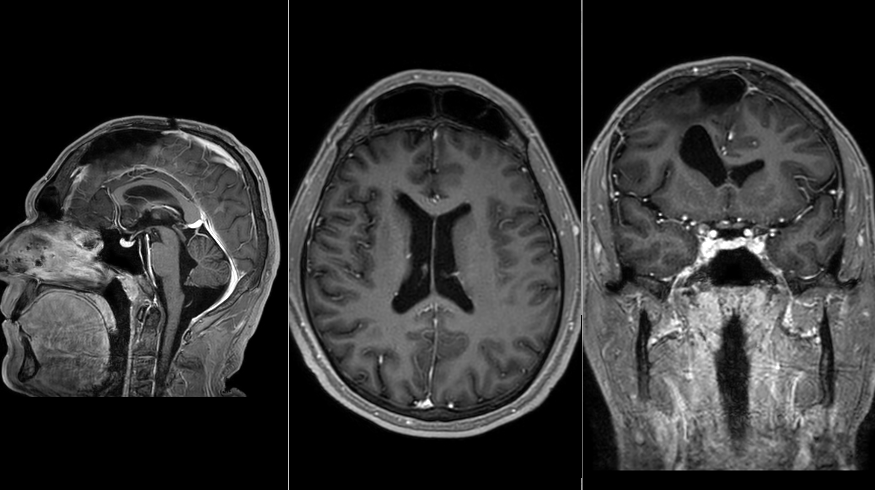 Postoperative scan after resection of a giant meningioma, showing the surgical result and successful tumor removal, and restoration of intracranial space.