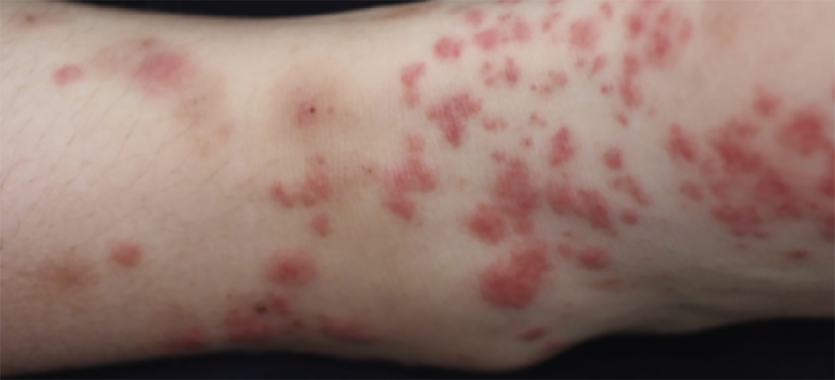 The association between erythema nodosum and pyoderma gangrenosum and ...