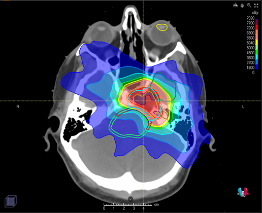 Proton Therapy FAQs for Breast Cancer - Johns Hopkins Medicine