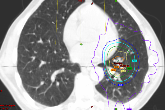 Prior SBRT plan for patient 