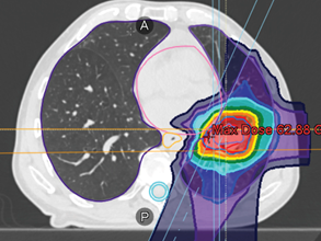 Proton treatment plan for re-irradiation, axial view (left) and coronal view (right)