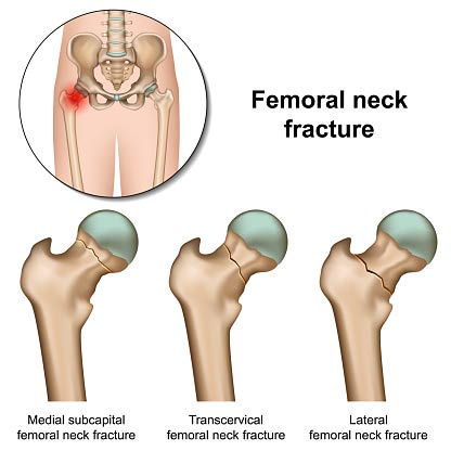 Femoral neck fracture