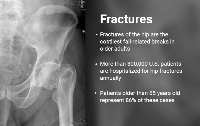 Fractures