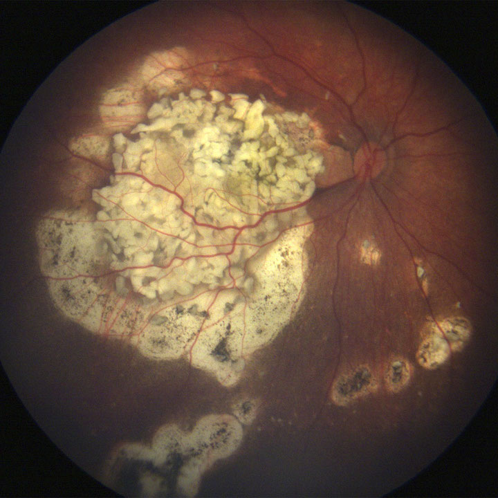 Retinoblastoma