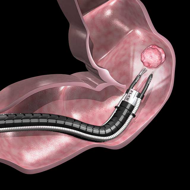 Robotic Endoscopic Resection